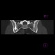 Hyperostosis triangularis ilii: CT - Computed tomography